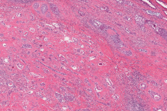Sclerosing mucoepidermoid carcinoma with eosinophilia of the thyroid gland