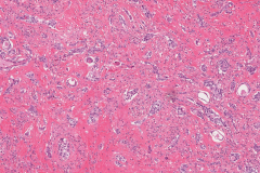 Sclerosing mucoepidermoid carcinoma with eosinophilia of the thyroid gland