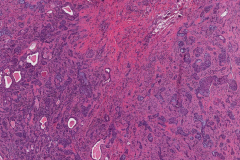 Sclerosing mucoepidermoid carcinoma with eosinophilia of the thyroid gland