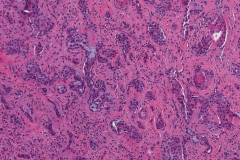Sclerosing mucoepidermoid carcinoma with eosinophilia of the thyroid gland