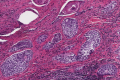 Sclerosing mucoepidermoid carcinoma with eosinophilia of the thyroid gland