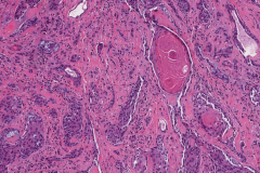 Sclerosing mucoepidermoid carcinoma with eosinophilia of the thyroid gland