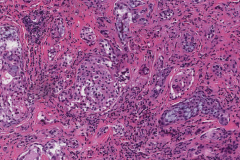 Sclerosing mucoepidermoid carcinoma with eosinophilia of the thyroid gland