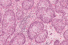 Sebaceous cell carcinoma involving the eyelid