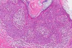 Seborrheic keratosis