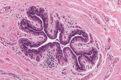In situ secretory carcinoma of the breast