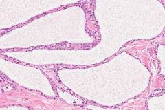 Serous cystadenoma of the pancreas