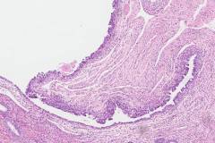 Serous intraepithelial carcinoma of the endometrium