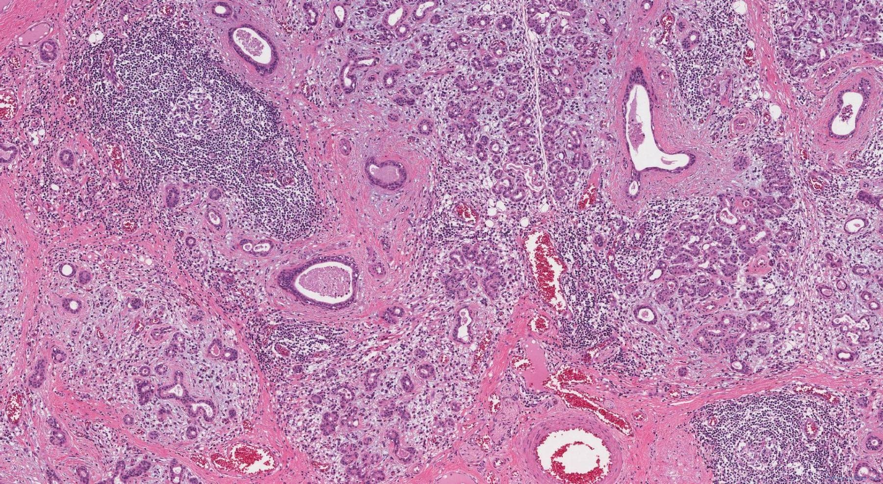 Sialodenitis Atlas Of Pathology