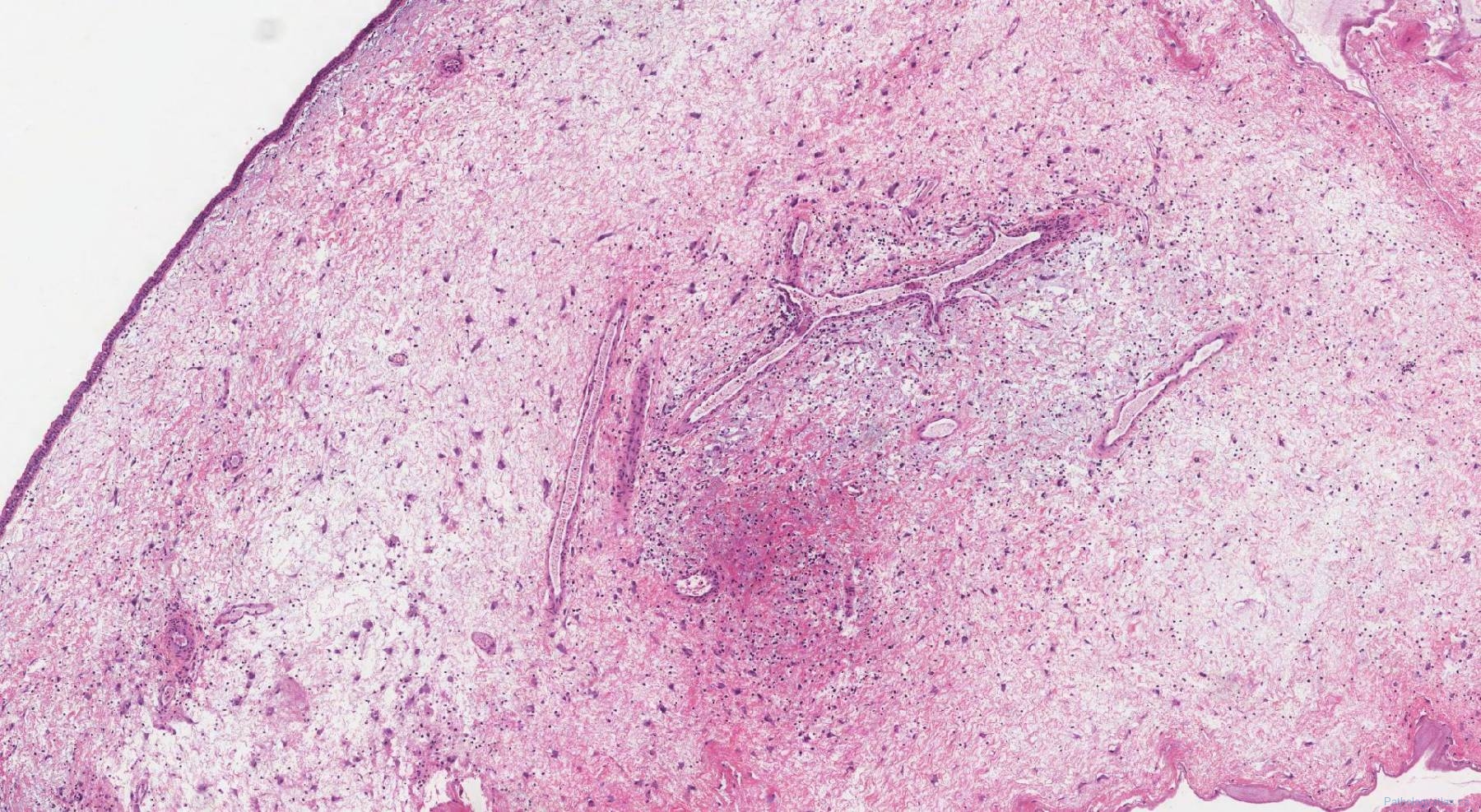 Sinonasal Inflammatory Polyp Atlas Of Pathology