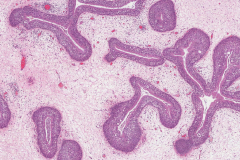 Inverted sinonasal papilloma arising from an inflammatory polyp