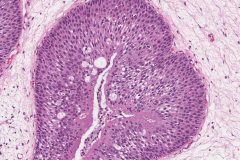 Inverted sinonasal papilloma arising from an inflammatory polyp