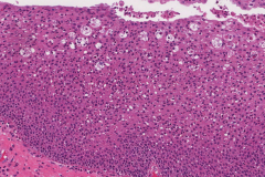 Inverted sinonasal papilloma arising from an inflammatory polyp