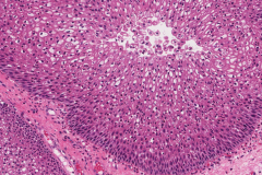 Inverted sinonasal papilloma arising from an inflammatory polyp