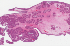 Inverted sinonasal papilloma arising from an inflammatory polyp