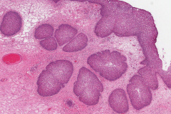 Inverted sinonasal papilloma arising from an inflammatory polyp