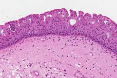 Oncocytic sinonasal papilloma