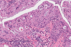 Oncocytic sinonasal papilloma