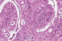 Oncocytic sinonasal papilloma