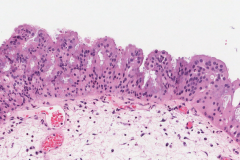 Oncocytic sinonasal papilloma