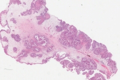 Oncocytic sinonasal papilloma