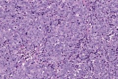 Sinonasal undifferentiated carcinoma