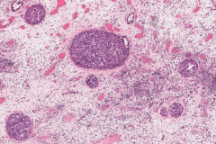 Sinonasal undifferentiated carcinoma