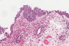 Sinonasal undifferentiated carcinoma