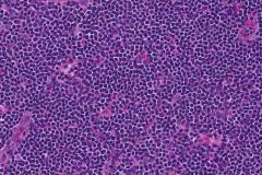 Small lymphocytic lymphoma in a lymph node