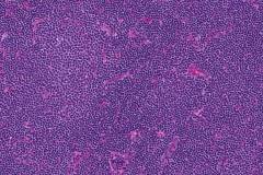 Small lymphocytic lymphoma in a lymph node