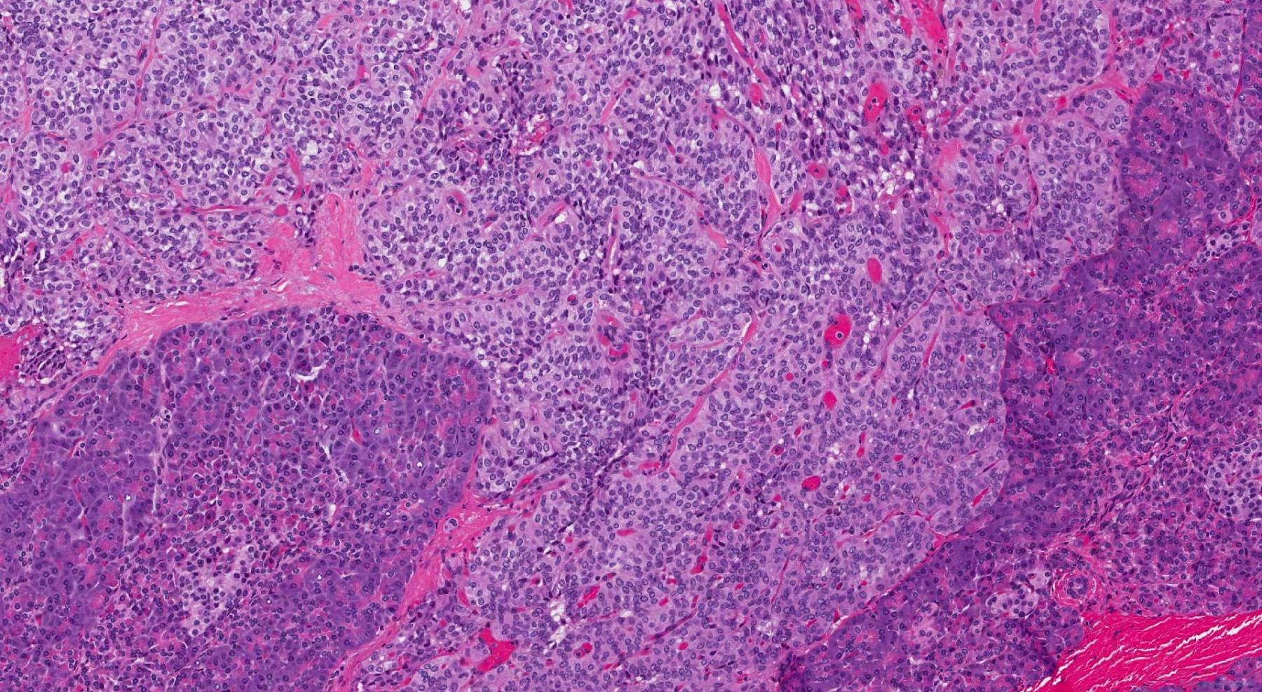 icd 10 code for pseudopapillary neoplasm of pancreas