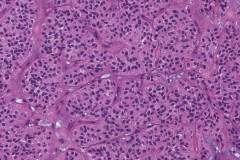 Solid pseudopapillary neoplasm of the pancreas