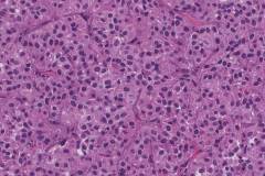 Solid pseudopapillary neoplasm of the pancreas