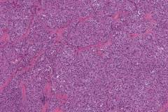 Solid pseudopapillary neoplasm of the pancreas