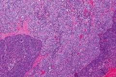 Solid pseudopapillary neoplasm of the pancreas