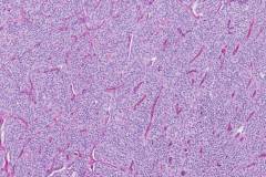 Solid pseudopapillary neoplasm of the pancreas