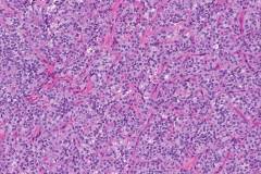 Solid pseudopapillary neoplasm of the pancreas
