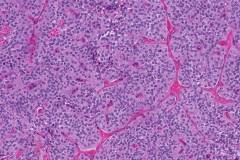 Solid pseudopapillary neoplasm of the pancreas