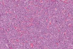 Solitary fibrous tumour of the kidney with high risk features