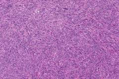 Spindle cell/sclerosing rhabdomyosarcoma