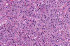 Spindle cell squamous cell carcinoma of the larynx