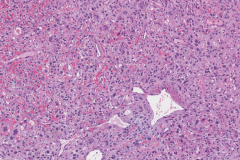 Spindle cell squamous cell carcinoma of the larynx