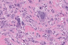 Spindle cell squamous cell carcinoma of the larynx