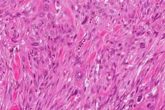 Spindle cell squamous cell carcinoma of the larynx