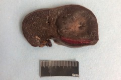 Splenic hamartoma