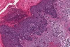 Squamous cell carcinoma in situ of the skin