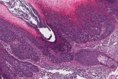 Squamous cell carcinoma in situ of the skin