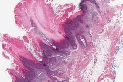 Squamous cell carcinoma in situ of the skin