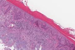 Squamous cell carcinoma in situ of the skin