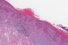 Squamous cell carcinoma in situ of the skin